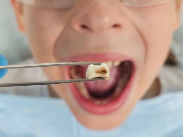 Best Emergency Dental Care for Broken or Chipped Teeth in Pinckneyvle, IL