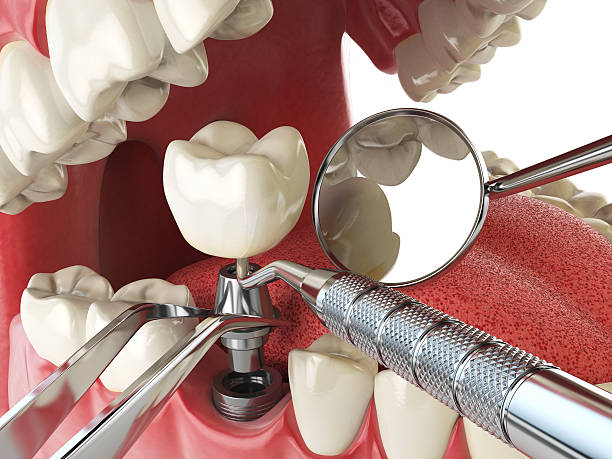 Best Emergency Tooth Extraction in Pinckneyvle, IL
